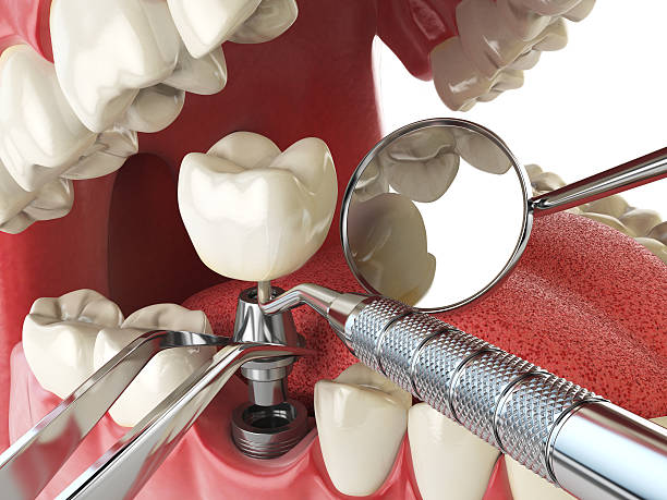 Best Dental Abscess Treatment in Martinsburg, PA